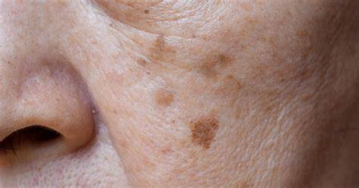 Are age spots raised?