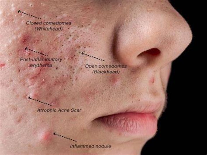 Are blackheads genetic?