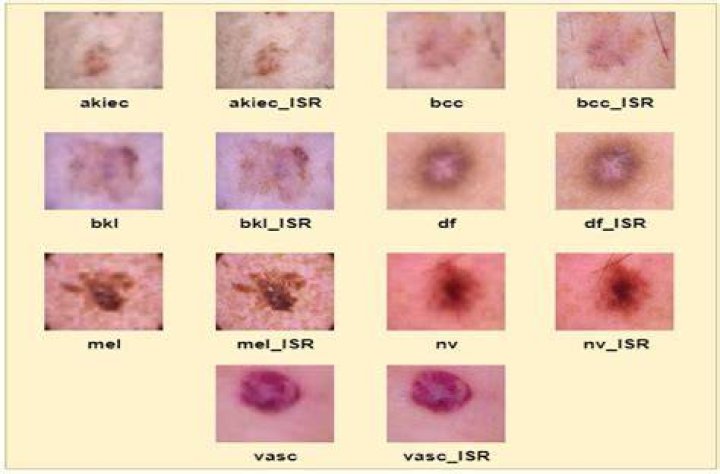 Are skin cancer spots raised or flat?