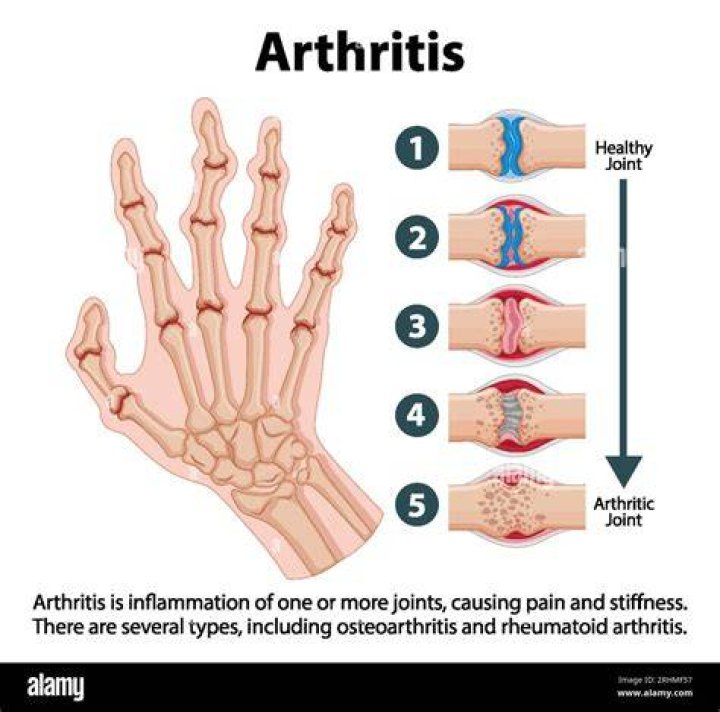 At what age does arthritis usually start?