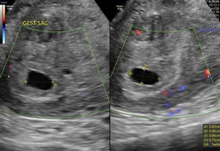 At what hCG level can you see a gestational sac?