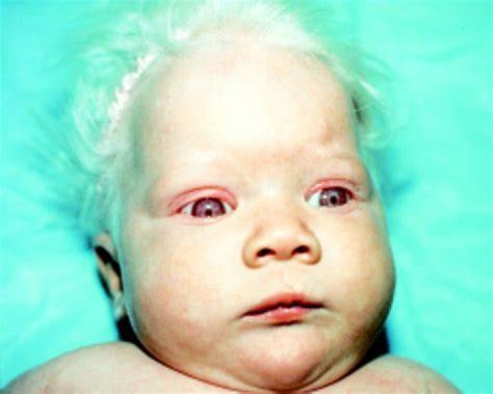 Can 2 albinos have a normal child?