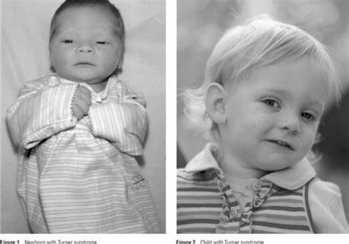 Can a baby survive with Turner syndrome?