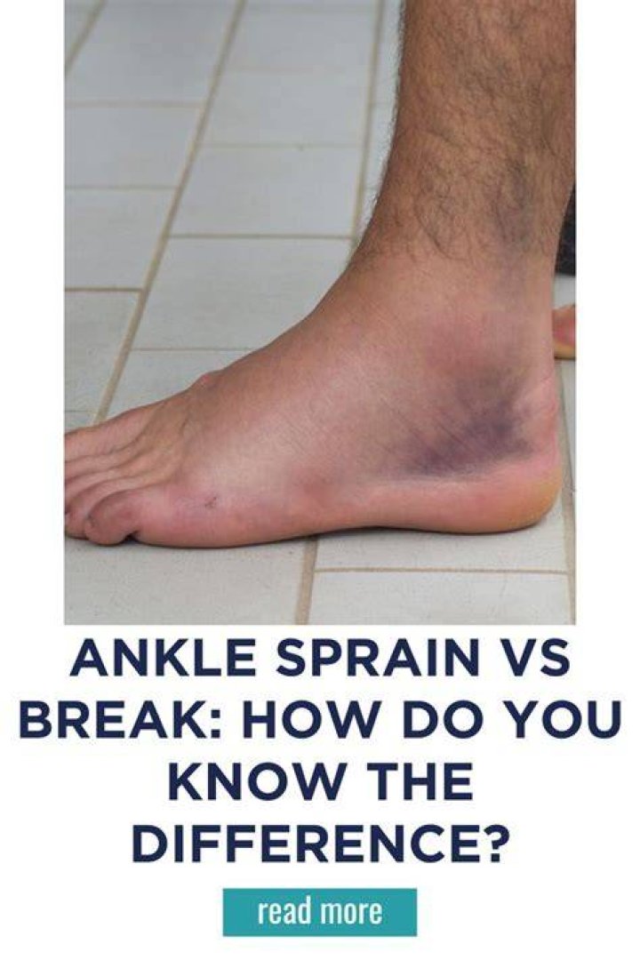 Can a sprain be mistaken for a fracture?