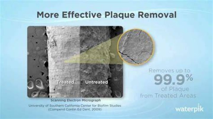 Can a Waterpik remove hard tartar?