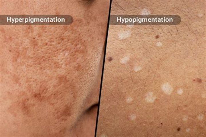 Can hypopigmentation go away?