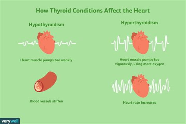 Can hypothyroidism affect your heart?