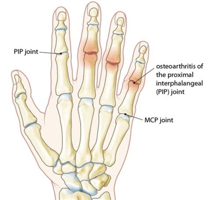 Can I get PIP with osteoarthritis?