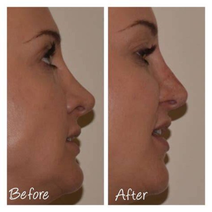 Can I reshape my nose without surgery?