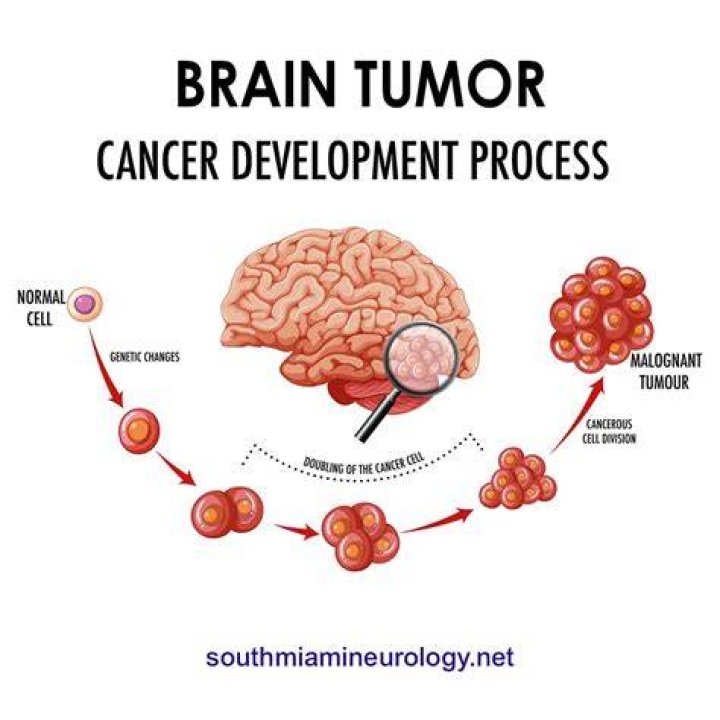 Can IUD cause brain tumor?