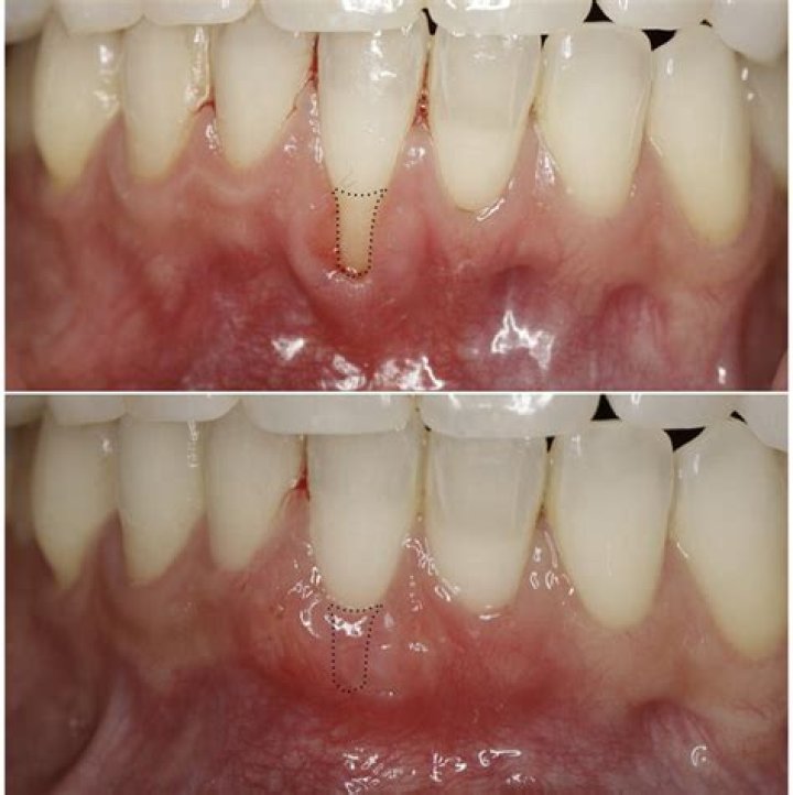 Can you dislodge a gum graft?