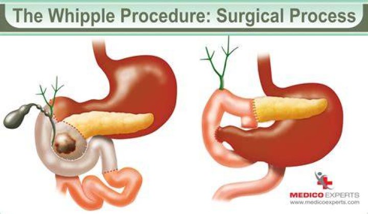 Can you drink coffee after Whipple surgery?