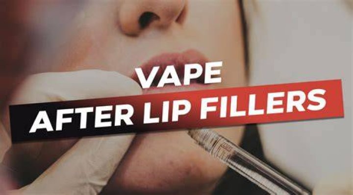 Can you vape after fillers?