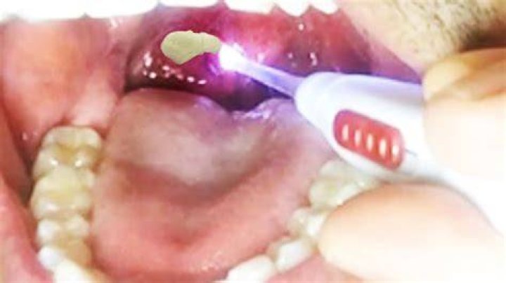 Do dentists remove tonsil stones?