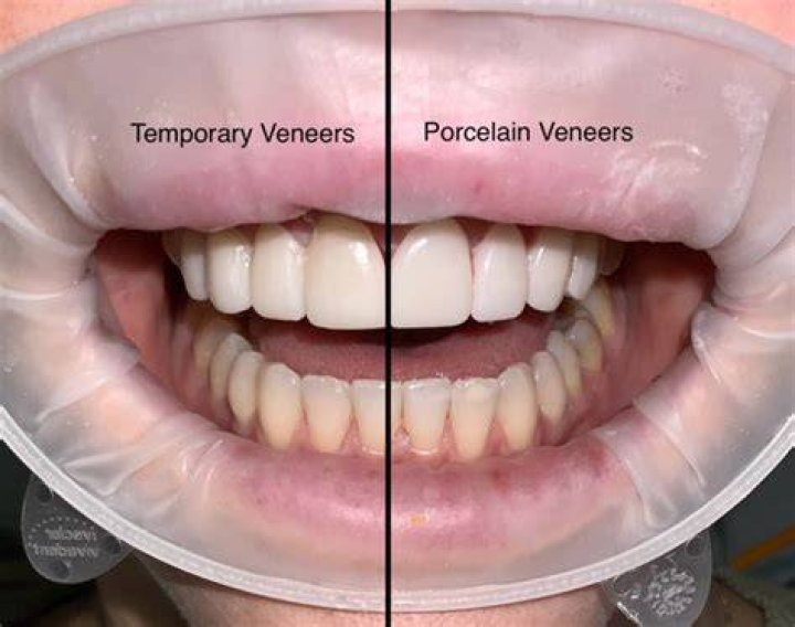 Do temporary veneers stain easily?