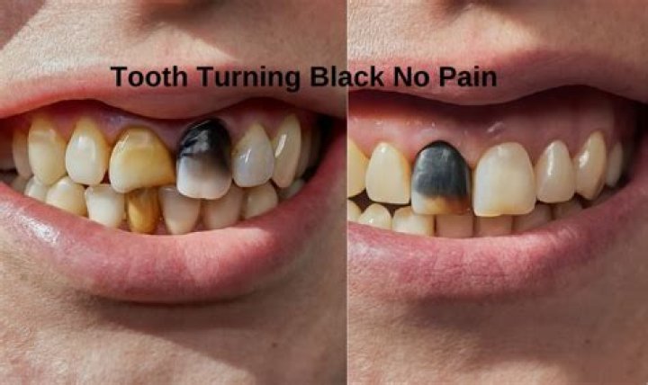 Does a cracked tooth turn black?