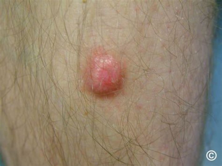 Does a dermatofibroma ever go away?