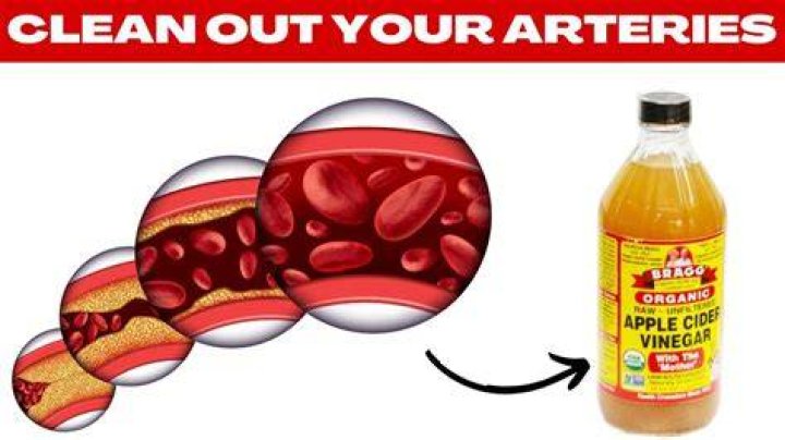 Does apple cider vinegar clean arteries?
