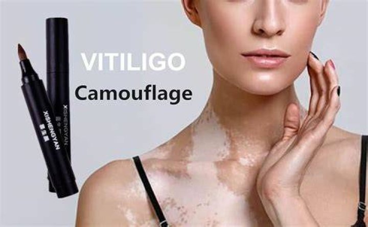 Does concealer cover vitiligo?