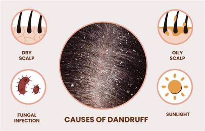 Does dandruff mean your hair is dirty?