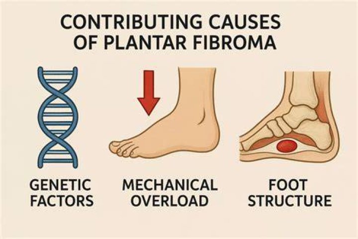 Does glucosamine cause plantar fibroma?