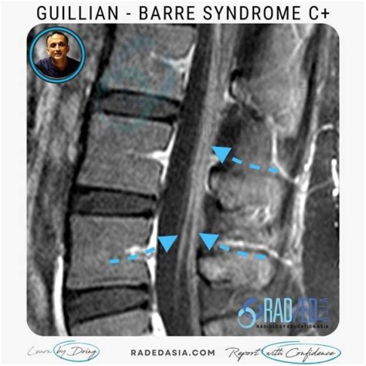Does Guillain Barre Show on MRI?