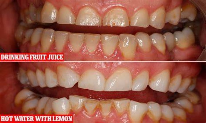 Does lime juice damage teeth?