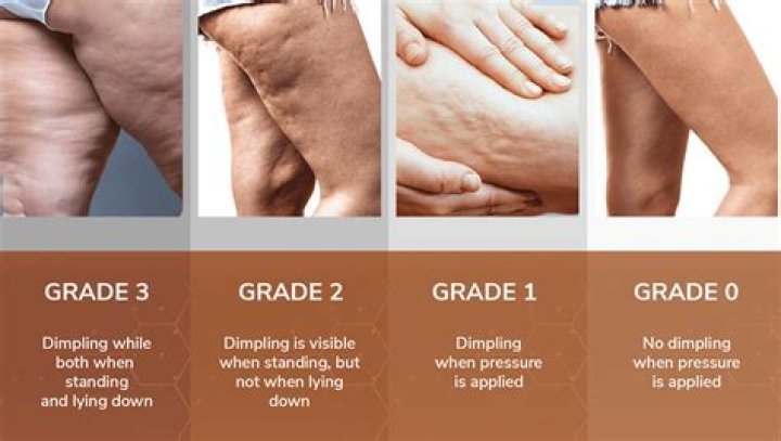 Does losing weight get rid of cellulite?
