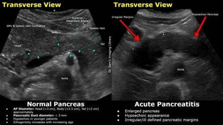 Does pancreatitis show up in a full blood count?
