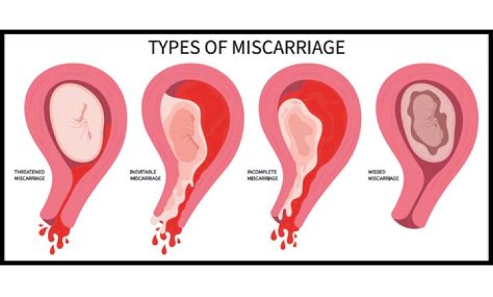How do I help my daughter through a miscarriage?