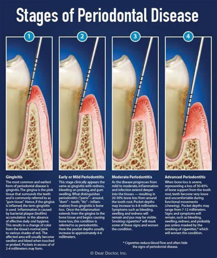 How do you fix periodontal pockets?
