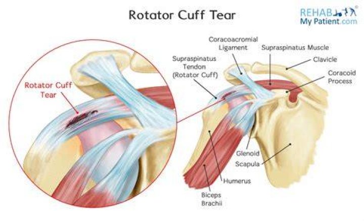 How do you tell if your rotator cuff is torn or strained?