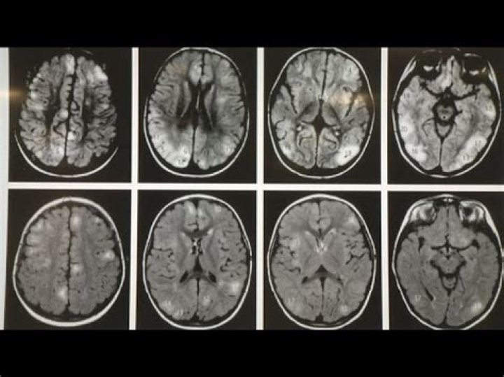 How fast can melanoma spread to the brain?