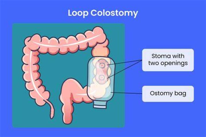How much can you lift with a stoma?