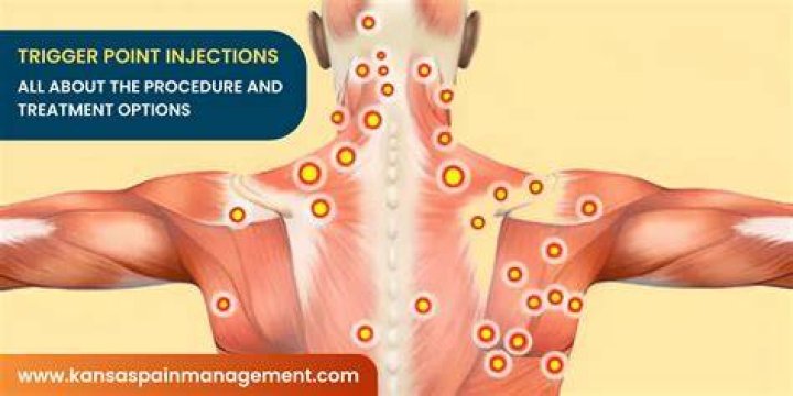 How often can you get trigger points?