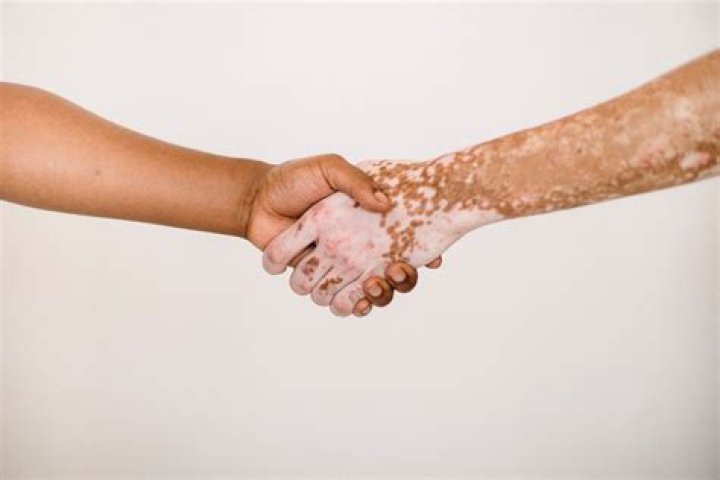 How vitiligo is diagnosed?
