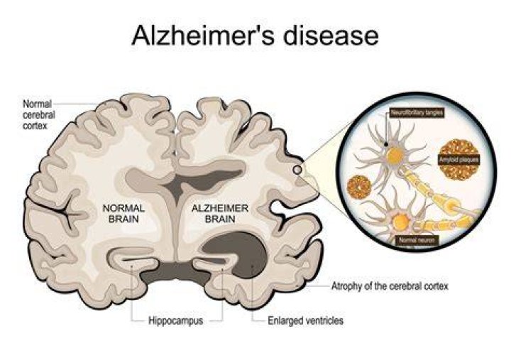 Is Alzheimer's hereditary from mother or father?