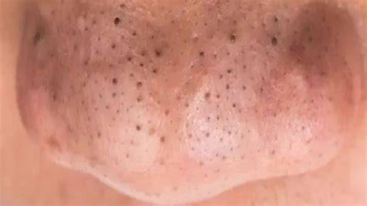 Is it OK to leave blackheads?
