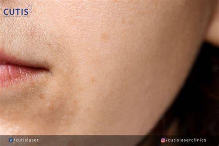 Is peach fuzz on girls Normal?
