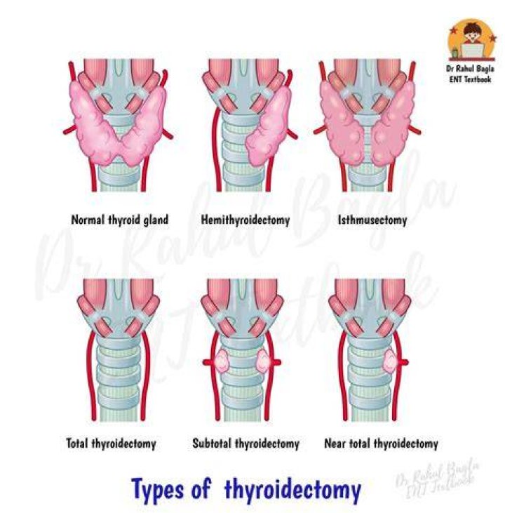 Is thyroid surgery high risk?