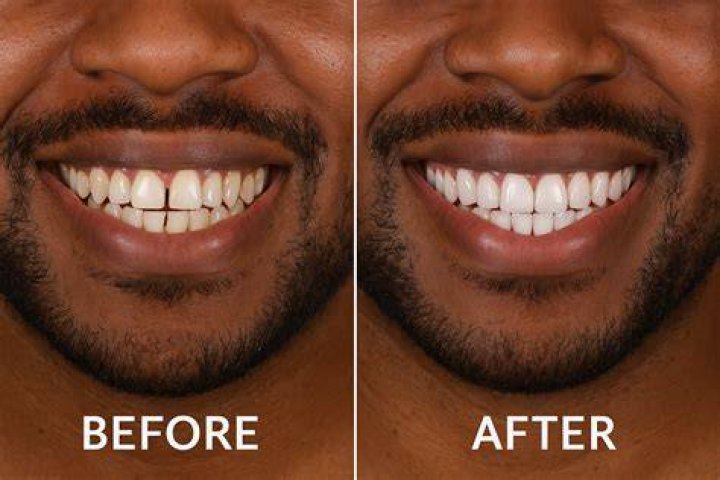 Should I whiten teeth before veneers?