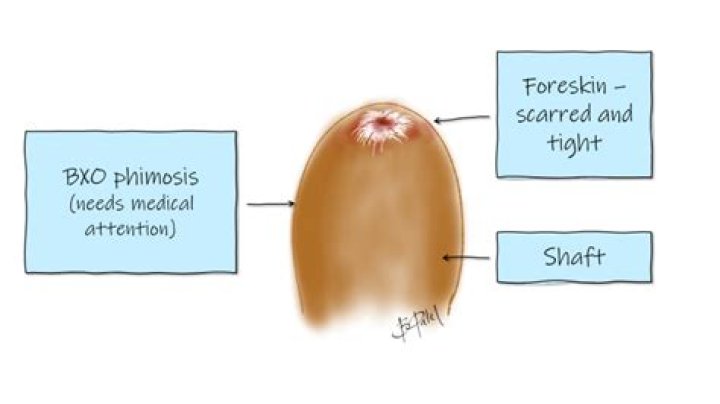 What age should you be able to pull your foreskin back?