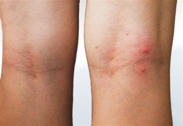 What bug bites behind the knees?