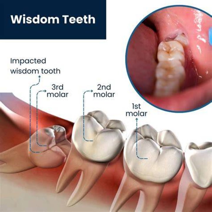 What do dentist do with wisdom teeth?