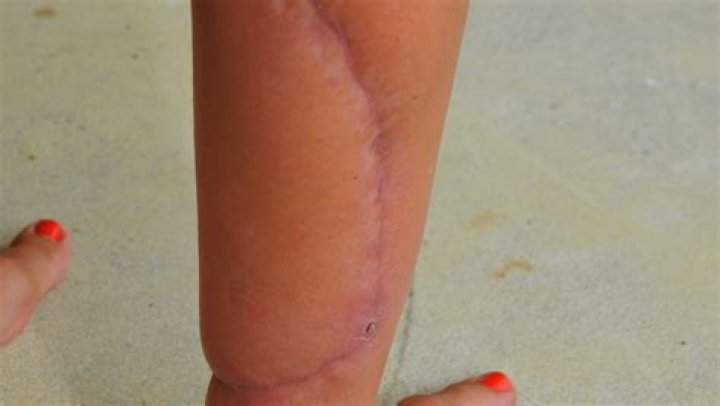 What do shark bites look like?