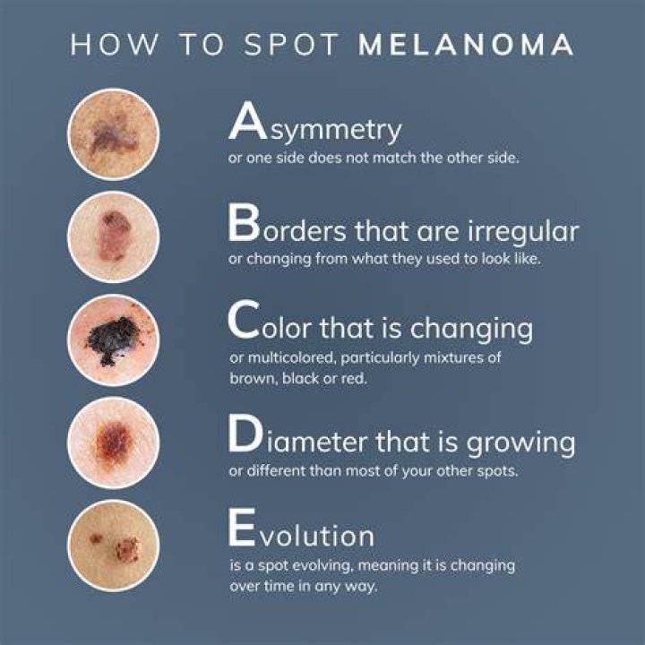 What does a melanoma spot look like?