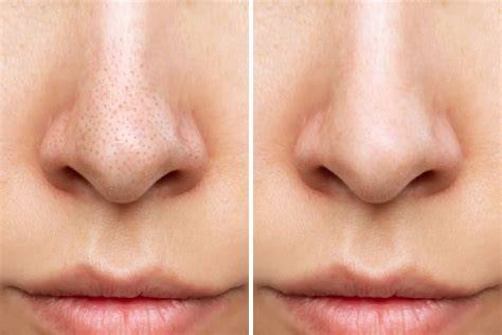What happens to pores when blackheads are removed?
