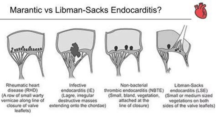 What is Libman Sacks endocarditis?