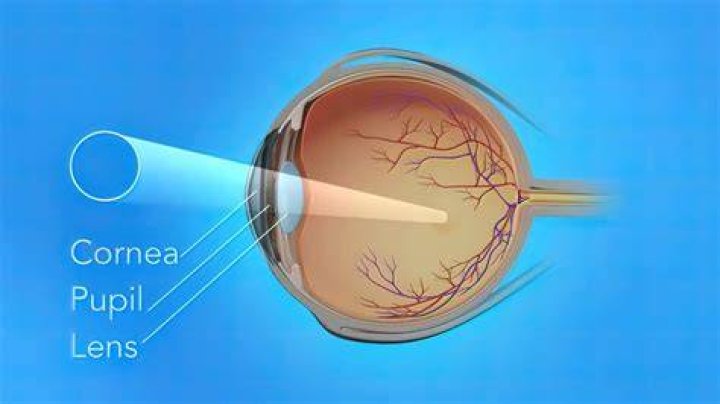 What is the main cause of cataract?