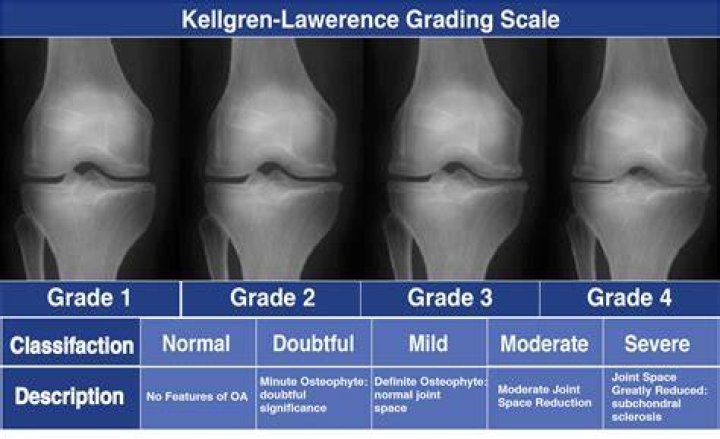 What is the most severe arthritis?